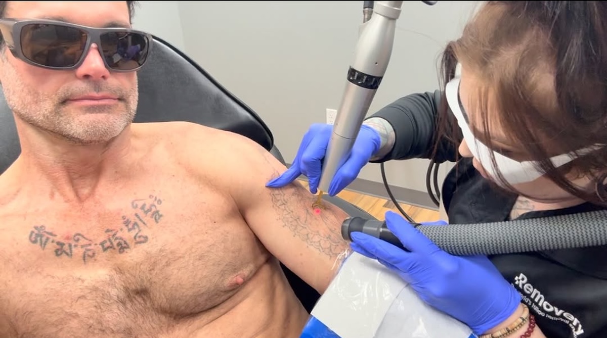 How Your Unique Tattoo Profile Affects Removal Time and Cost ...